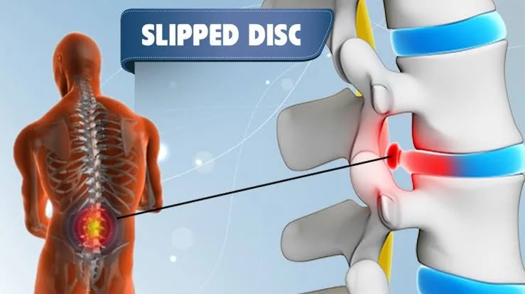 Illustration labelled ‘Slipped Disc’ showing a lower-back area and a highlighted spinal disc.